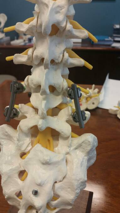 A model of Allan McKeering's spinal plates and screws.